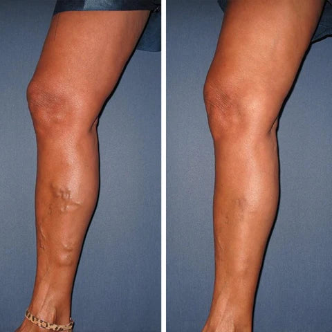 Oveallgo™ VeinCare MagAcupoint Reflexology Insole ( BUY 1 GET 1 FREE )