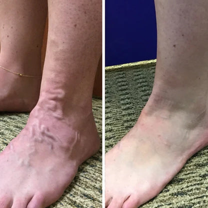 Oveallgo™ VeinCare MagAcupoint Reflexology Insole ( BUY 1 GET 1 FREE )