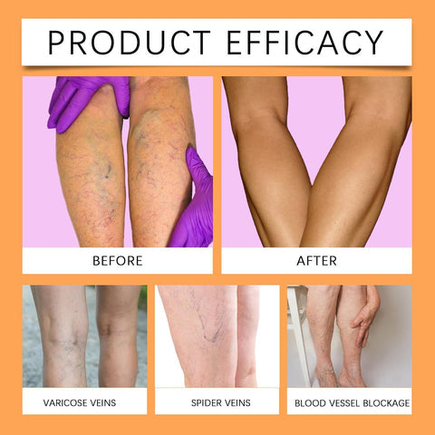 Turmeric Varicose Vein Relief Spray( BUY 1 GET 2 FREE💥 🎁  )
