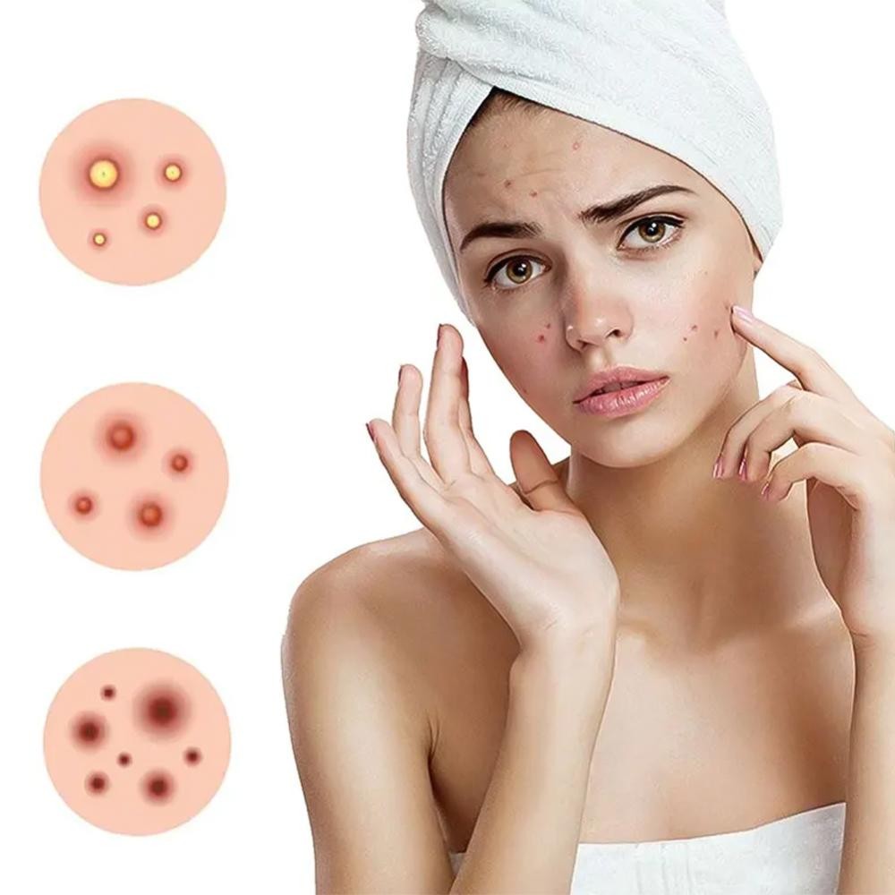 Premium Star Shaped Pimple Patches Pack Of 200