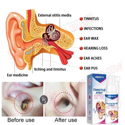 HBESTY Tinnitus Spray Multi-Symptom Relief  ( BUY 1 GET 1 FREE )